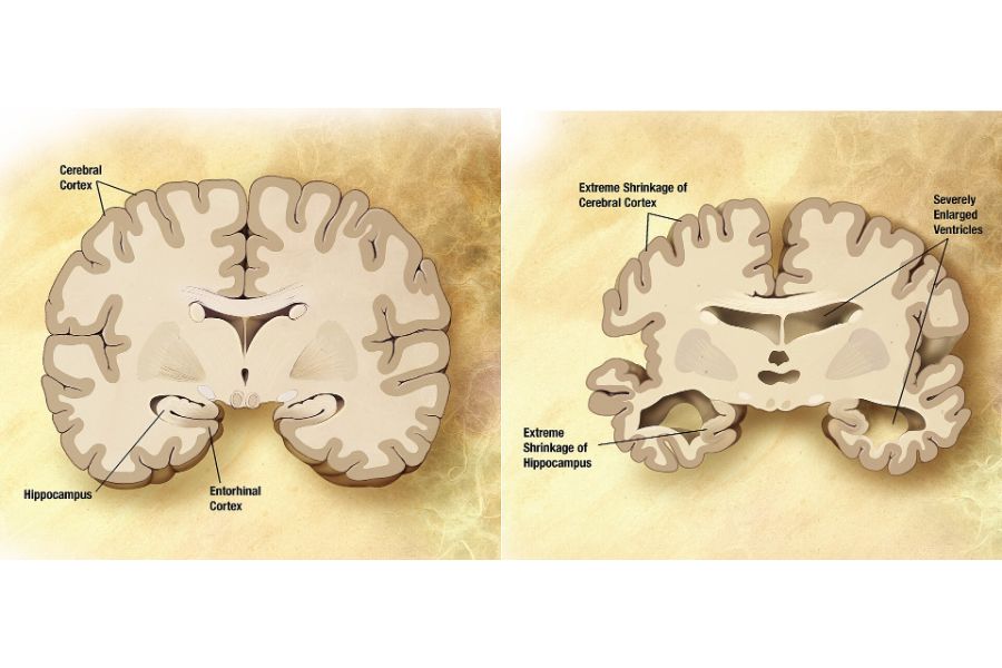 Gesundes Gehirn und Gehirn bei schwerer Alzheimer-Krankheit im Querschnitt